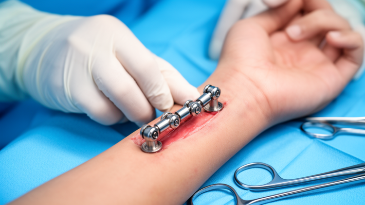 First-in-human wrist implant with two rotation centers shows early stability in five patients