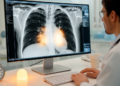 Visual Score Reads Heart Fat on Routine CT Scans in About a Minute