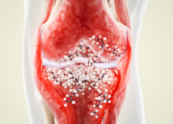 Synovitis severity may steer JAK inhibitor response in difficult-to-treat rheumatoid arthritis