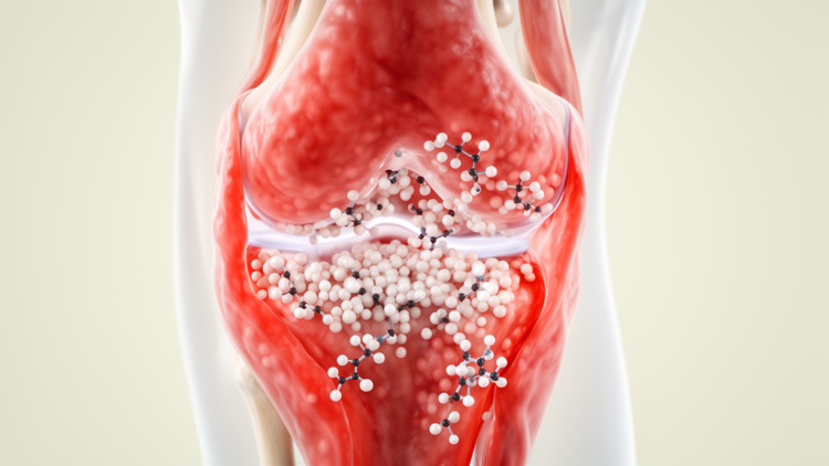 Synovitis severity may steer JAK inhibitor response in difficult-to-treat rheumatoid arthritis