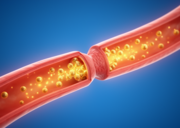 Mathematical model probes gold nanoparticle heat transport in a narrowed artery