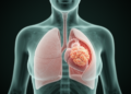 Rare Chest-Only High-Grade Serous Carcinoma Reported in 60-Year-Old Woman