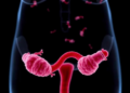 How Gut Bacteria May Drive Insulin Resistance in Polycystic Ovary Syndrome