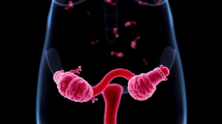 How Gut Bacteria May Drive Insulin Resistance in Polycystic Ovary Syndrome