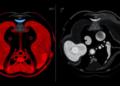 Ovarian Cancer AI Study Retracted After Ultrasound Dataset Turns Out to Contain Thyroid Images