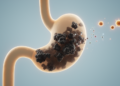Cholangiocarcinoma: New Advances Expose Stubborn Gaps in a Deadly Bile Duct Cancer