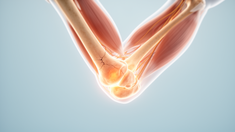 Floating elbow injuries in children fare no worse than isolated humeral fractures in surgical study