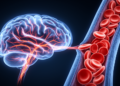 Stroke Prevention in Sickle Cell Disease Still Rests on Decades-Old Trials