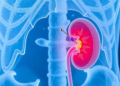 Freezing Kidney Tumors With Needles Shows Five-Year Success Against Papillary Renal Cancer