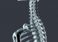 Binary 'Skeletal Failure' Rule Proposed to Make AI Vertebral Fracture Screening Trustworthy
