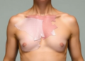 One Flap, Many Shapes: Surgeons Tailor a Single Tissue Flap to Rebuild Chest and Arm Defects