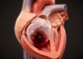 Rare Balloon-Like Cardiac Myxoma Mimicked a Blood-Filled Cyst