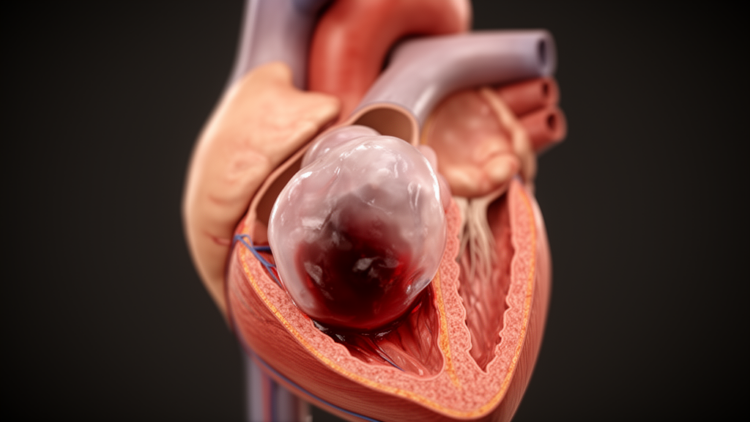 Rare Balloon-Like Cardiac Myxoma Mimicked a Blood-Filled Cyst