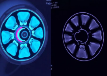 Radiotherapy Still Matters in dMMR Endometrial Cancer, Researchers Warn in the Immunotherapy Era