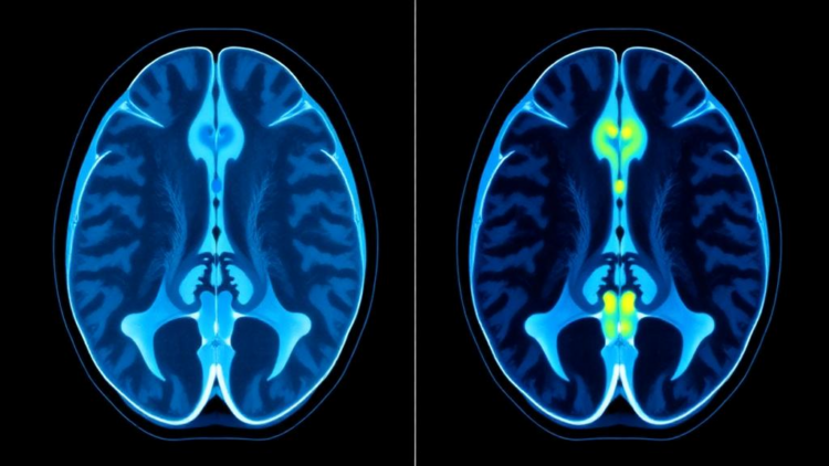 Muscle fat-free area on lumbar MRI outperforms VBQ score for osteoporosis detection