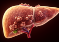 Immune structures inside liver tumours linked to better immunotherapy outcomes
