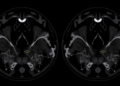 Calcium Clues: Ultrasound Patterns That Reveal Cancerous Salivary Gland Tumors