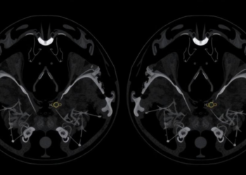 Calcium Clues: Ultrasound Patterns That Reveal Cancerous Salivary Gland Tumors
