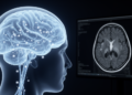 MRI Index Tied to the Brain's Waste Clearance System May Be Misleading in Epilepsy
