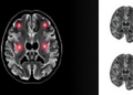 Random-Walk MRI Physics Predicts How Hard a Brain Tumor Is Before Surgery