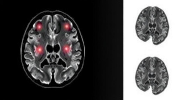 Random-Walk MRI Physics Predicts How Hard a Brain Tumor Is Before Surgery