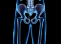 Routine Blood Test Marker RDW Linked to Higher Hip Fracture Risk in Older Adults