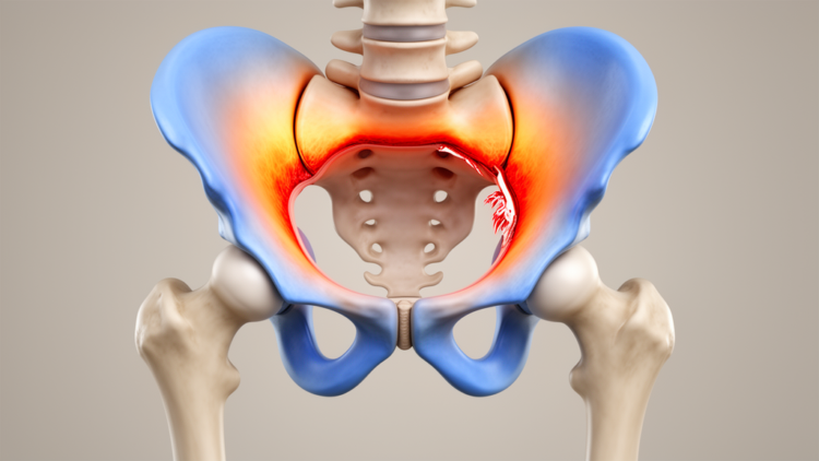 Severe labral tears in dysplastic hips concentrate stress in the upper acetabulum
