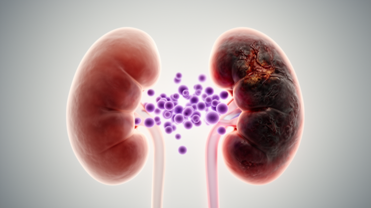 Severe Baseline Kidney Impairment Predicts Long-Term Kidney Failure Risk in Myeloma