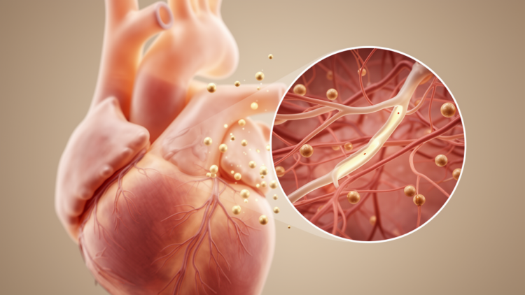 Microvascular Disease May Link Diabetes to Heart Failure With Preserved Ejection Fraction