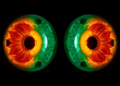 Corneal digital twins move from simplified shapes to patient-specific simulations