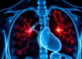 Moderate aortic stenosis is deadlier than thought, and imaging may unmask it