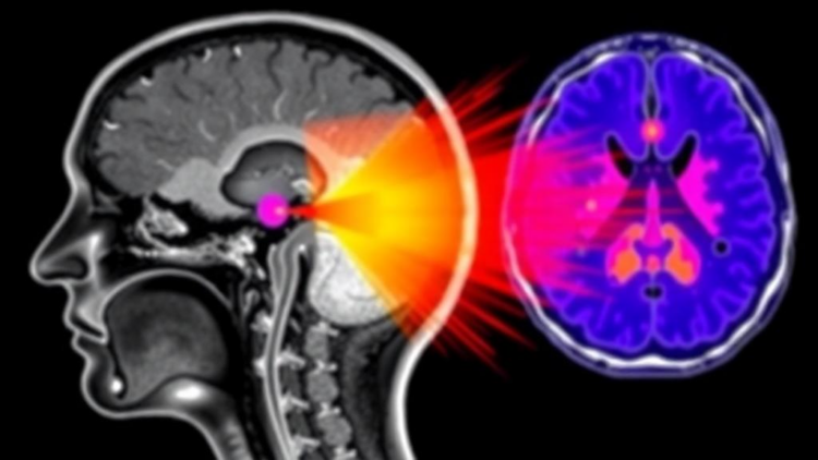 MRI-Based Centiloid Methods Prove Most Reliable for Amyloid PET Scoring