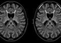 AI Reads the Diaphragm in Seconds on Routine Thoracic MRI, Multireader Study Finds