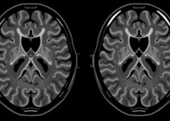 AI Reads the Diaphragm in Seconds on Routine Thoracic MRI, Multireader Study Finds