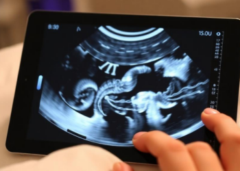 Ultrasound-guided tracheostomy proves safe option in COVID-19 ICU patients