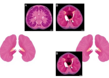 Rare SWI/SNF-Deficient Sinonasal Carcinomas Characterized in 10-Case Study