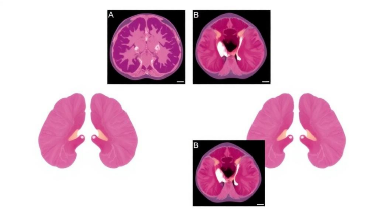 Rare SWI/SNF-Deficient Sinonasal Carcinomas Characterized in 10-Case Study