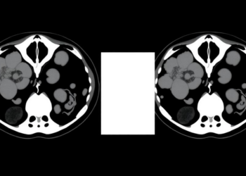CT-based habitat radiomics flags heavy nodal spread in thyroid cancer, with caveats