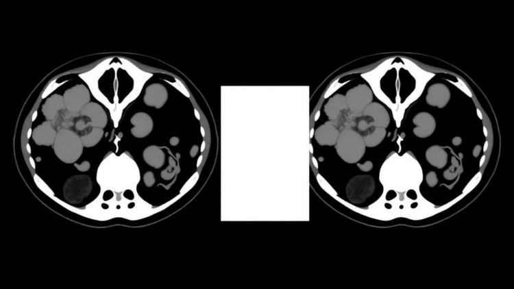 CT-based habitat radiomics flags heavy nodal spread in thyroid cancer, with caveats