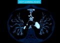 Deep Learning Reads Chest CT Scans to Stage COVID-19 Patients Faster