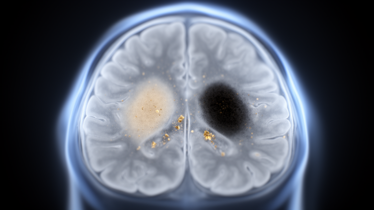 MRI reveals nigrosome-1 neuromelanin and iron changes in Parkinson disease
