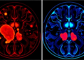 MRI Radiomics Model Predicts Breast Cancer Chemotherapy Response by Reading the Tumor and Its Surroundings