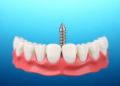 Bone Density, Not Torque Alone, Decides Whether Immediate Dental Implants Survive