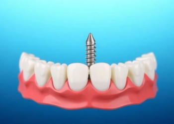 Bone Density, Not Torque Alone, Decides Whether Immediate Dental Implants Survive
