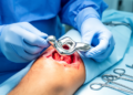 Knee Replacement Study Finds Patellar Resurfacing Cuts Reoperations, Not Pain