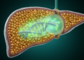 Astragaloside IV Eases Fatty Liver by Epigenetically Silencing a Lipogenesis Switch