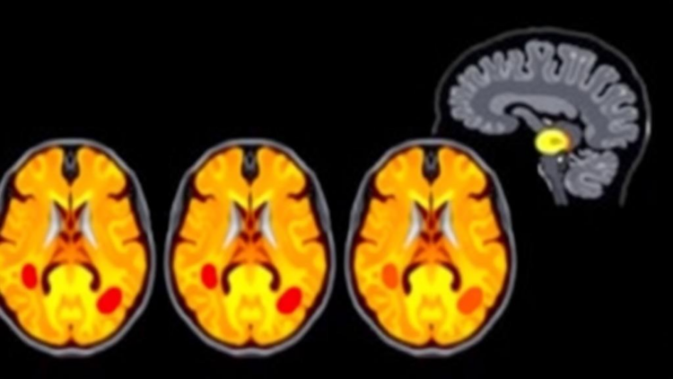 AI Framework Spots MS Lesions With Record Accuracy by Fusing MRI and Clinical Data