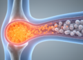 Haploidentical transplants show lower relapse risk for MRD-positive AML patients in EBMT registry analysis