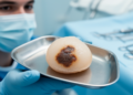 Research report: Melanin pigmented dentigerous cyst report of a case and review of relevant literature