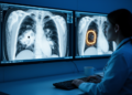 AI Spots Lung Cancer Hiding Behind a Veil of Pneumonia on CT Scans